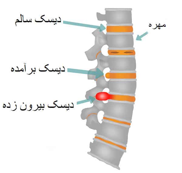 ورزش-درمانی-برای-کمر-درد-و-سیاتیک-علائم-دیسک-کمر-عوامل-ایجاد-و-درمان-آن