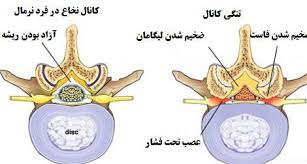 دلایل و درمان تنگی کانال نخاعی